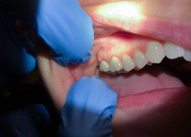 Best Emergency Tooth Extraction in Williamston, SC