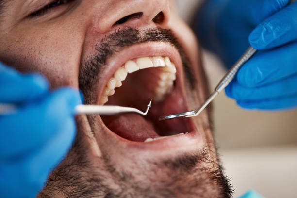 Best Emergency Root Canal Treatment in Williamston, SC